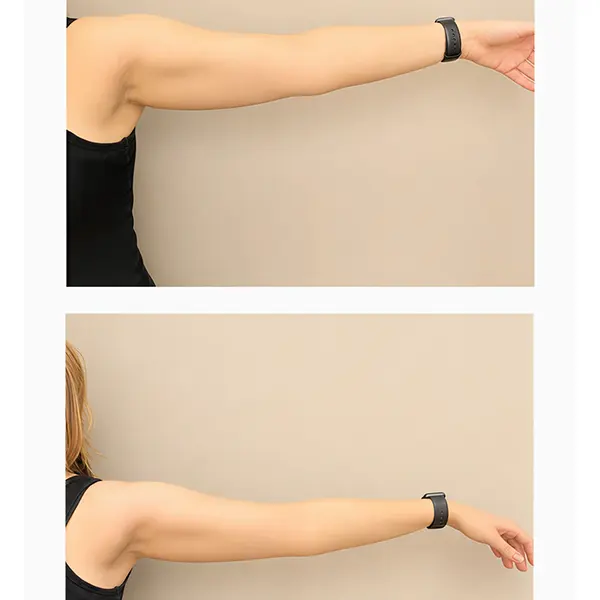Resultados en brazos Antes y después Firming & Body Shaping Cream Endor en brazos